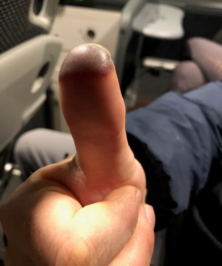 Frostbitten thumb